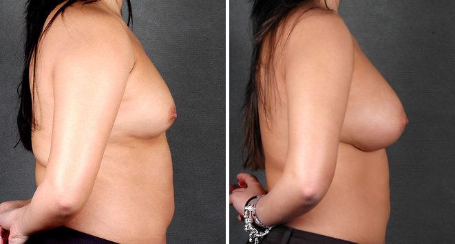 Breast Augmentation Before and After Photos in Omaha, NE, Case 4225