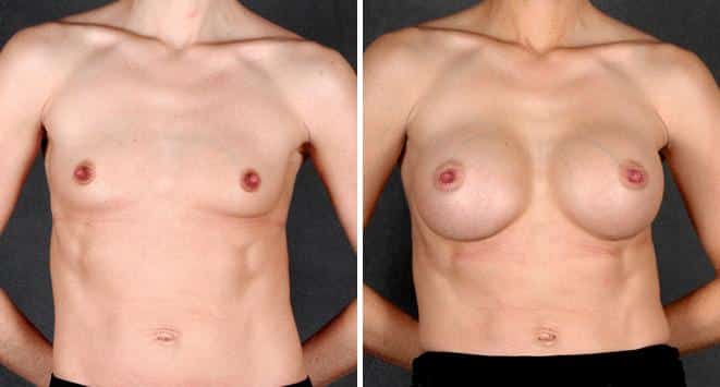 Breast Augmentation Before and After Photos in Omaha, NE, Case 4255