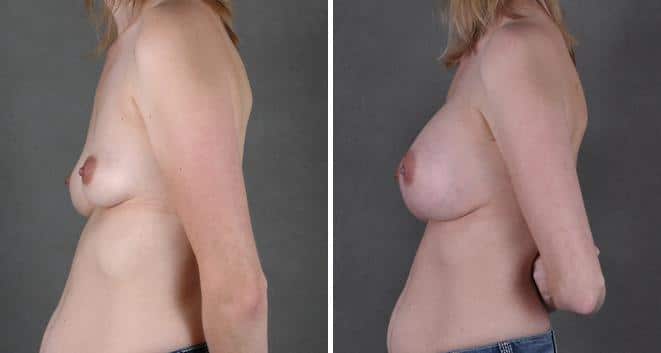 Breast Augmentation Before and After Photos in Omaha, NE, Case 4056