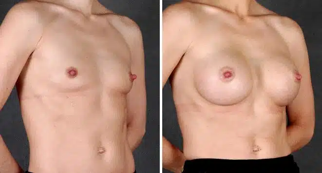 Breast Augmentation Before and After Photos in Omaha, NE, Case 4255