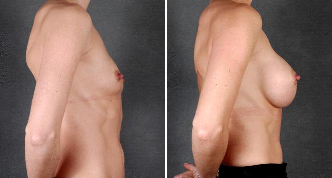 Breast Augmentation Before and After Photos in Omaha, NE, Case 4255