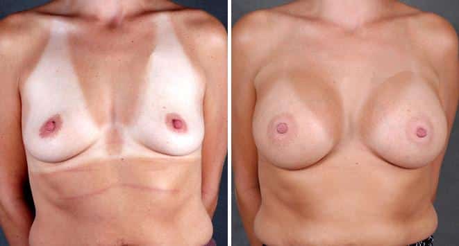 Breast Augmentation Before and After Photos in Omaha, NE, Case 4085