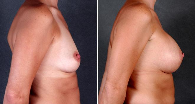 Breast Augmentation Before and After Photos in Omaha, NE, Case 4085