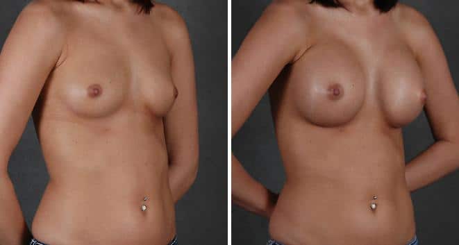 Breast Augmentation Before and After Photos in Omaha, NE, Case 4103