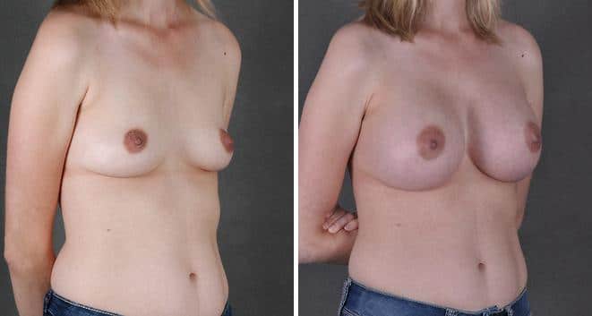 Breast Augmentation Before and After Photos in Omaha, NE, Case 4056