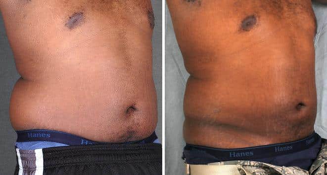 Liposuction Before and After Photos in Omaha, NE, Case 4185