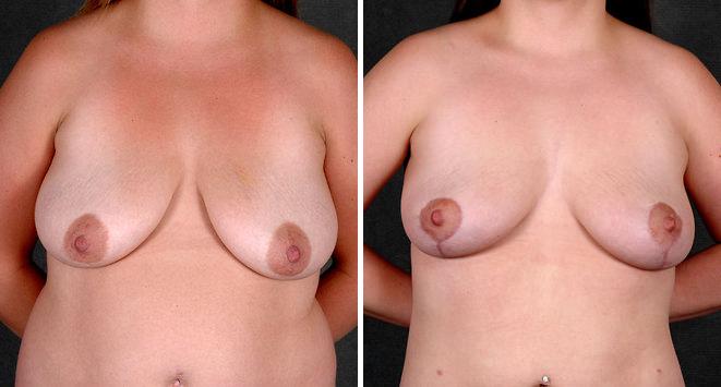 Liposuction Before and After Photos in Omaha, NE, Case 4226