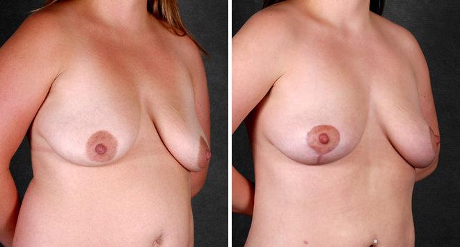 Liposuction Before and After Photos in Omaha, NE, Case 4226