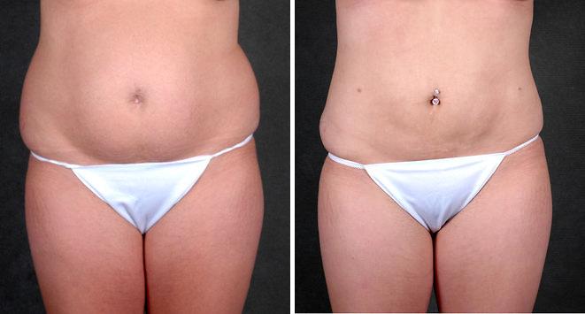 Liposuction Before and After Photos in Omaha, NE, Case 4226