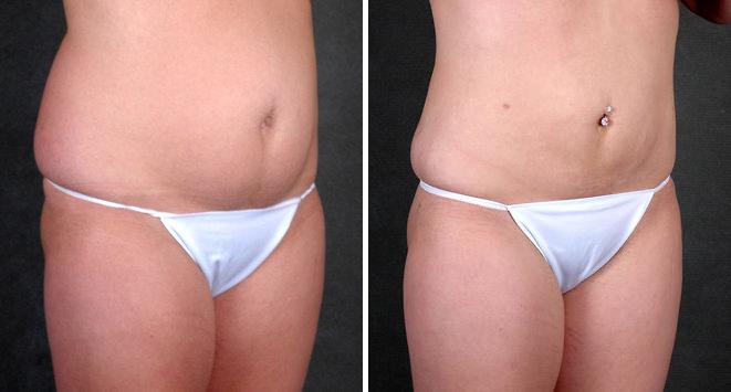 Liposuction Before and After Photos in Omaha, NE, Case 4226