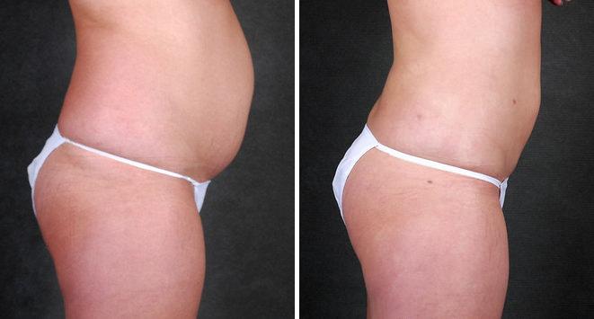 Liposuction Before and After Photos in Omaha, NE, Case 4226