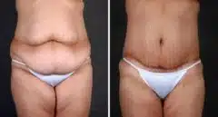 Liposuction Before and After Photos in Omaha, NE, Case 4239