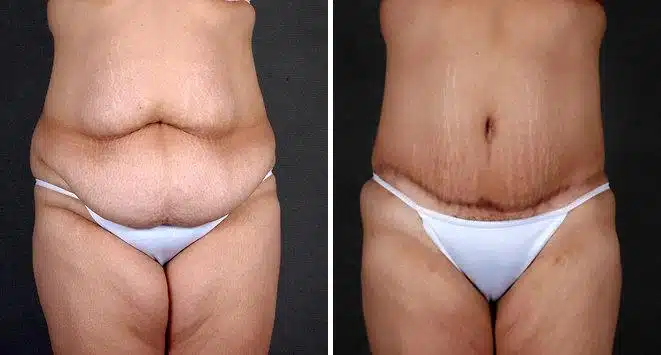 Liposuction Before and After Photos in Omaha, NE, Case 4239