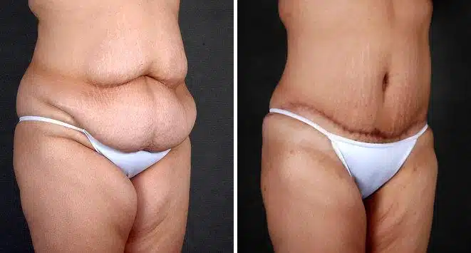 Liposuction Before and After Photos in Omaha, NE, Case 4239