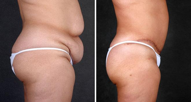 Liposuction Before and After Photos in Omaha, NE, Case 4239