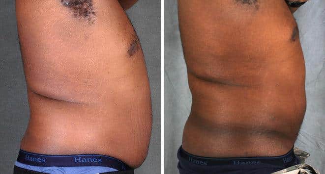 Liposuction Before and After Photos in Omaha, NE, Case 4185