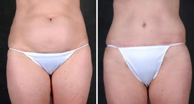 Liposuction Before and After Photos in Omaha, NE, Case 4254