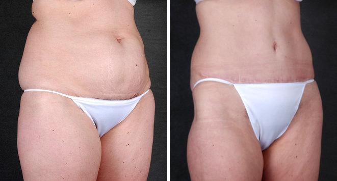 Liposuction Before and After Photos in Omaha, NE, Case 4254