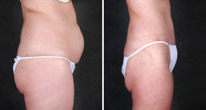 Liposuction Before and After Photos in Omaha, NE, Case 4254