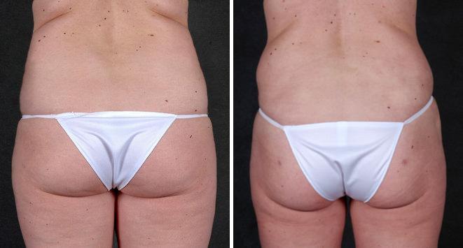 Liposuction Before and After Photos in Omaha, NE, Case 4254