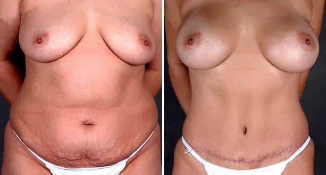 Liposuction Before and After Photos in Omaha, NE, Case 4270