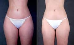 Liposuction Before and After Photos in Omaha, NE, Case 4276