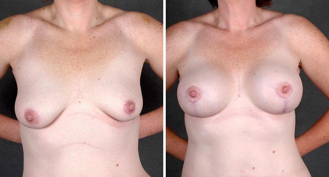 Liposuction Before and After Photos in Omaha, NE, Case 4287