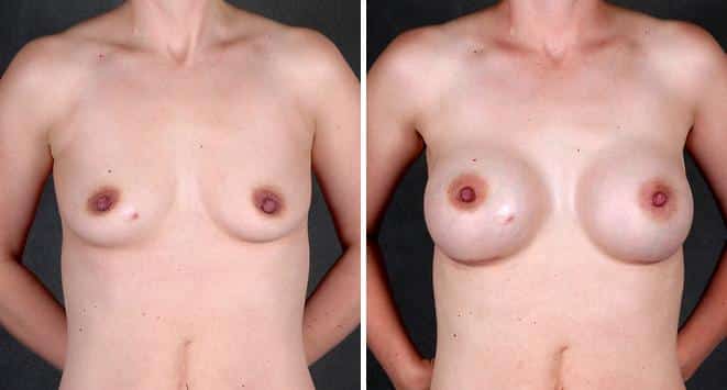 Case 4210, Liposuction Before and After Photos Liposuction Before and After Photos in Omaha, NE, Case 4210