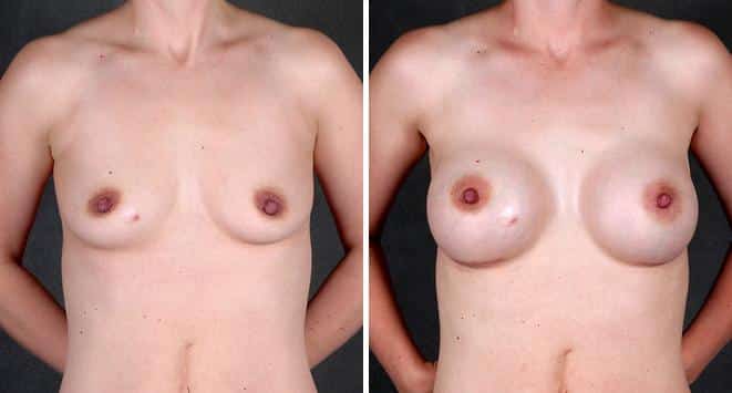 Liposuction Before and After Photos in Omaha, NE, Case 4210