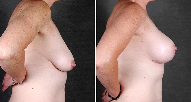 Liposuction Before and After Photos in Omaha, NE, Case 4287