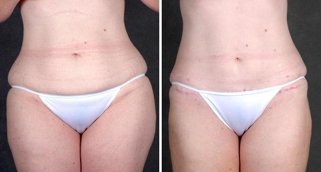 Liposuction Before and After Photos in Omaha, NE, Case 4287