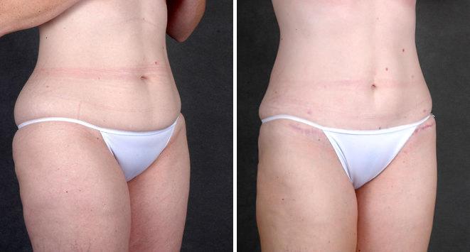 Liposuction Before and After Photos in Omaha, NE, Case 4287