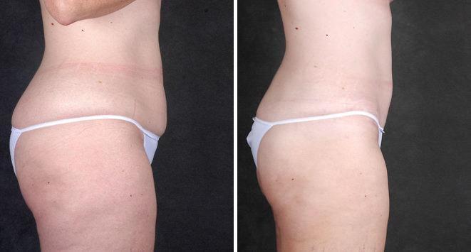 Liposuction Before and After Photos in Omaha, NE, Case 4287