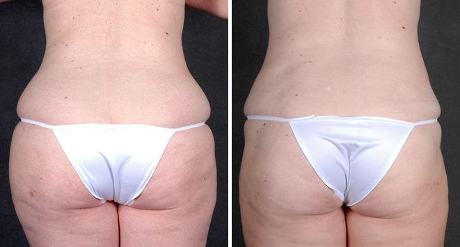 Liposuction Before and After Photos in Omaha, NE, Case 4287