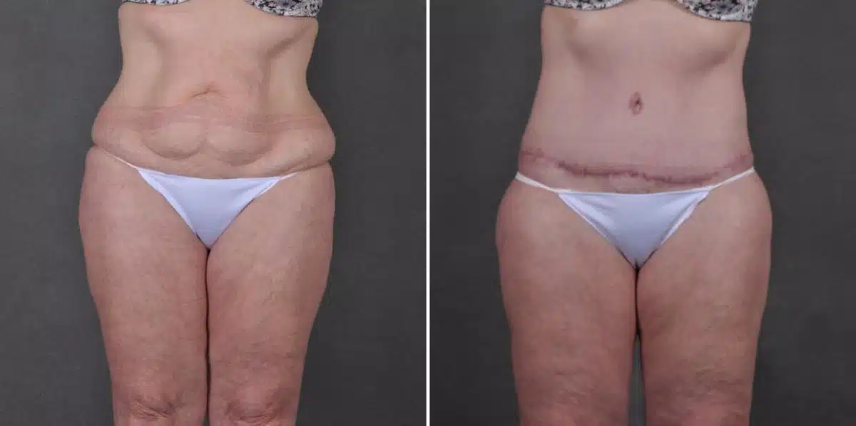 Liposuction Before and After Photos in Omaha, NE, Case 7785