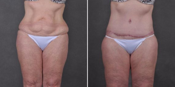 Liposuction Before and After Photos in Omaha, NE, Case 7785