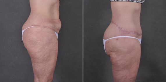 Liposuction Before and After Photos in Omaha, NE, Case 7785