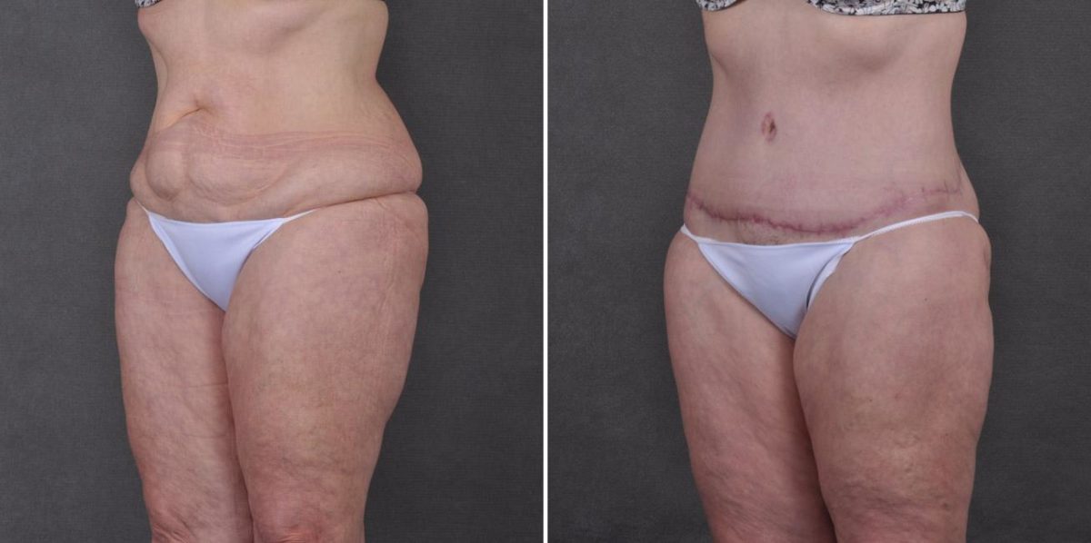 Liposuction Before and After Photos in Omaha, NE, Case 7785