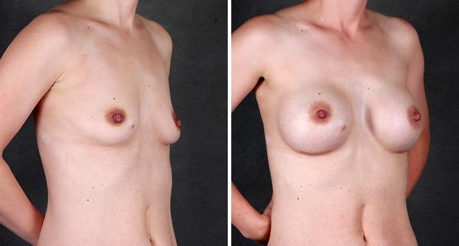 Liposuction Before and After Photos in Omaha, NE, Case 4210