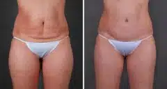 Liposuction Before and After Photos in Omaha, NE, Case 7860