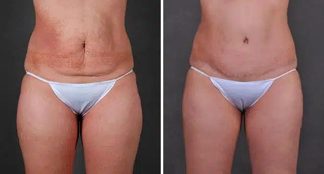 Liposuction Before and After Photos in Omaha, NE, Case 7860