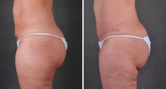 Liposuction Before and After Photos in Omaha, NE, Case 7860