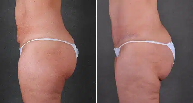 Liposuction Before and After Photos in Omaha, NE, Case 7860