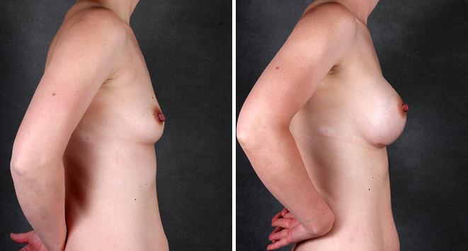 Liposuction Before and After Photos in Omaha, NE, Case 4210