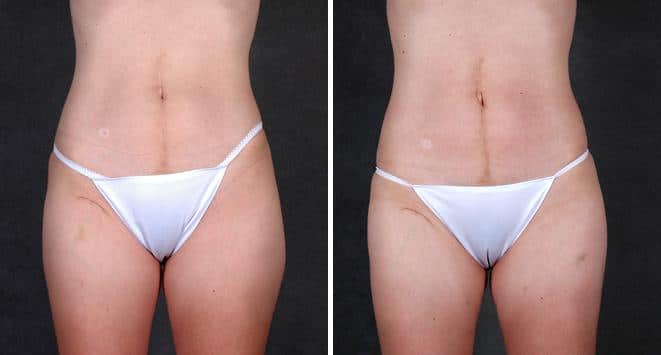 Case 4210, Liposuction Before and After Photos Liposuction Before and After Photos in Omaha, NE, Case 4210