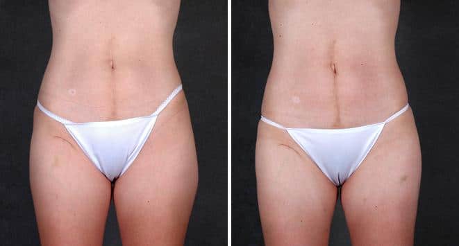 Liposuction Before and After Photos in Omaha, NE, Case 4210