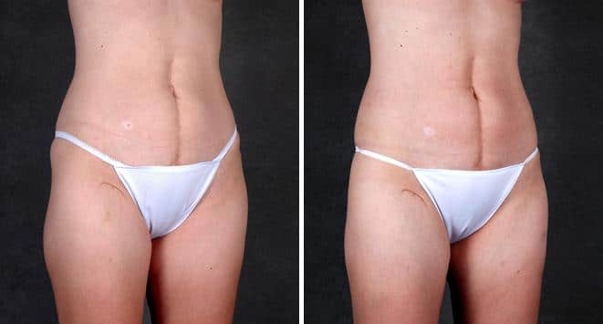 Liposuction Before and After Photos in Omaha, NE, Case 4210