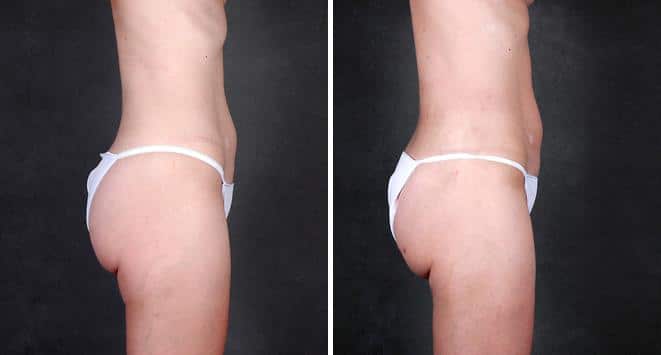Case 4210, Liposuction Before and After Photos Liposuction Before and After Photos in Omaha, NE, Case 4210