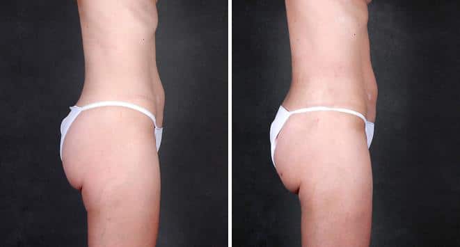 Liposuction Before and After Photos in Omaha, NE, Case 4210