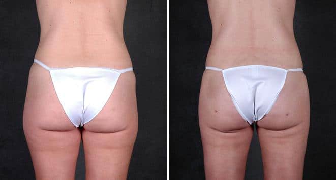 Case 4210, Liposuction Before and After Photos Liposuction Before and After Photos in Omaha, NE, Case 4210